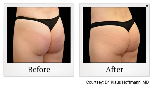 results of Emsculpt NEO treatment in Santa Clara