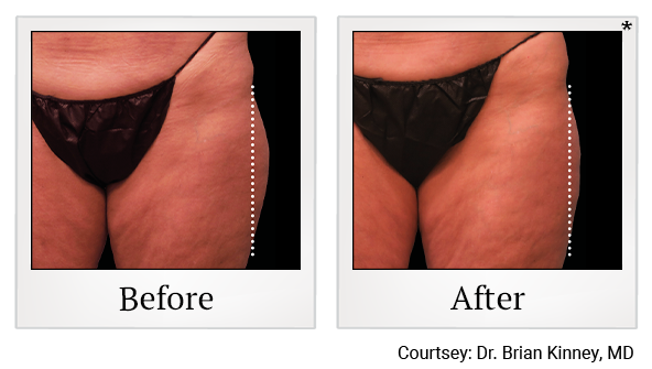 results of Emsculpt NEO treatment in Santa Clara