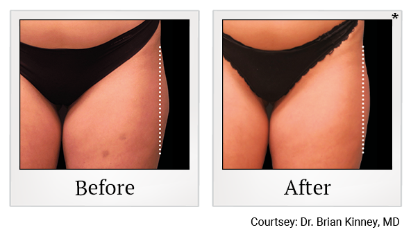 results of Emsculpt NEO treatment in Santa Clara