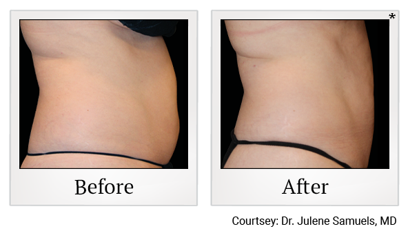 results of Emsculpt NEO treatment in Santa Clara