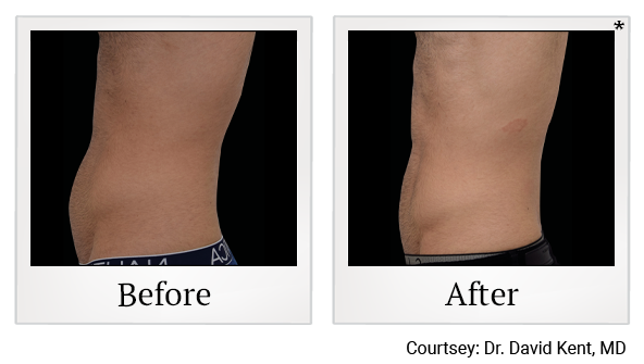 results of Emsculpt NEO treatment in Santa Clara