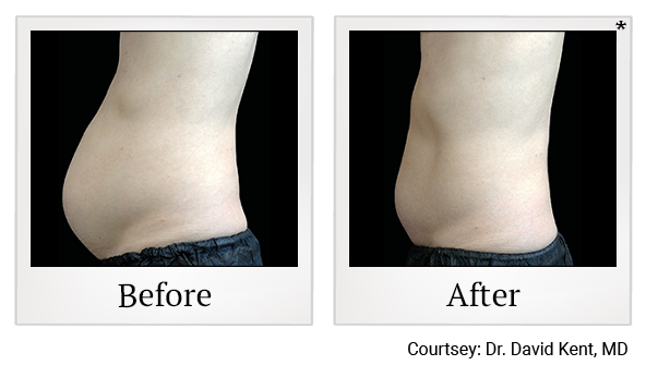 results of Emsculpt NEO treatment in Santa Clara