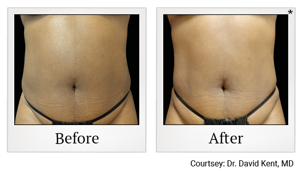 results of Emsculpt NEO treatment in Santa Clara