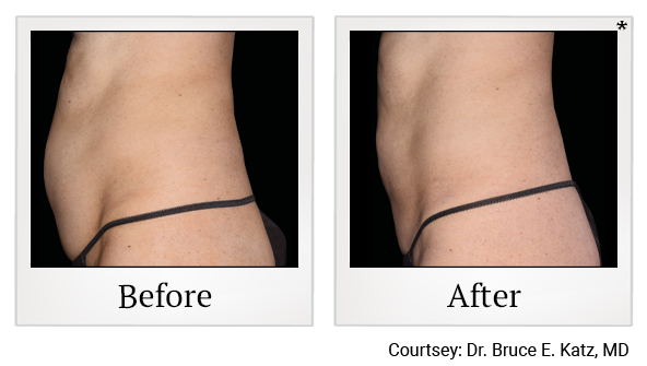 results of Emsculpt NEO treatment in Santa Clara