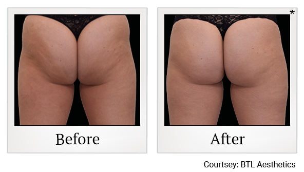 results of Emsculpt NEO treatment in Santa Clara